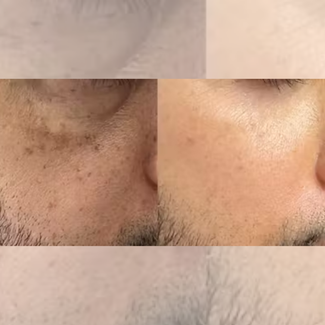 Pigmentation Treatment